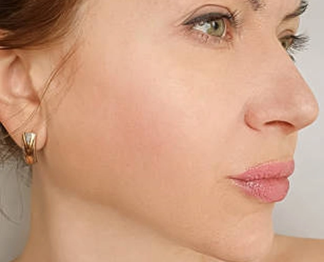 Face lift after