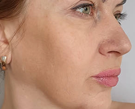 Face lift before