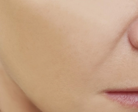 Laser skin cleansing After