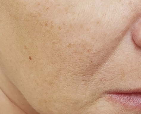 Laser skin cleansing Before