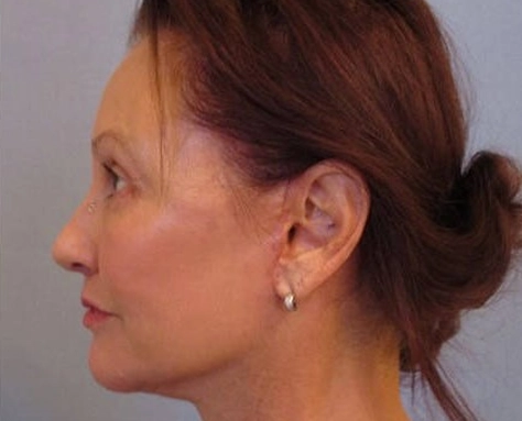 facelift after