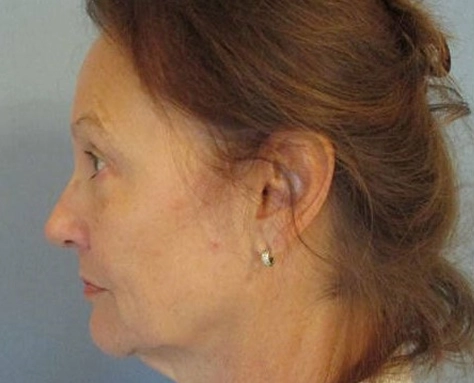 facelift left