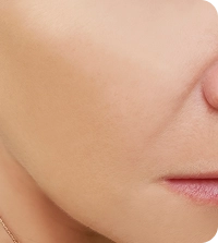Monica R. - Laser skin cleansing