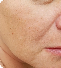 Monica R. - Laser skin cleansing