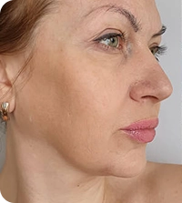 Sarah D.- Face lift