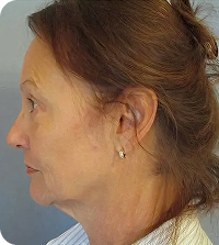 High SMAS facelift