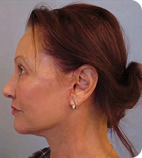 High SMAS facelift