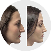 Nose & Rhinoplasty