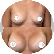 Breast